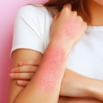 Eczema Disease