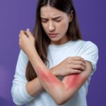 Eczema disease
