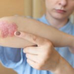 Psoriasis Disease