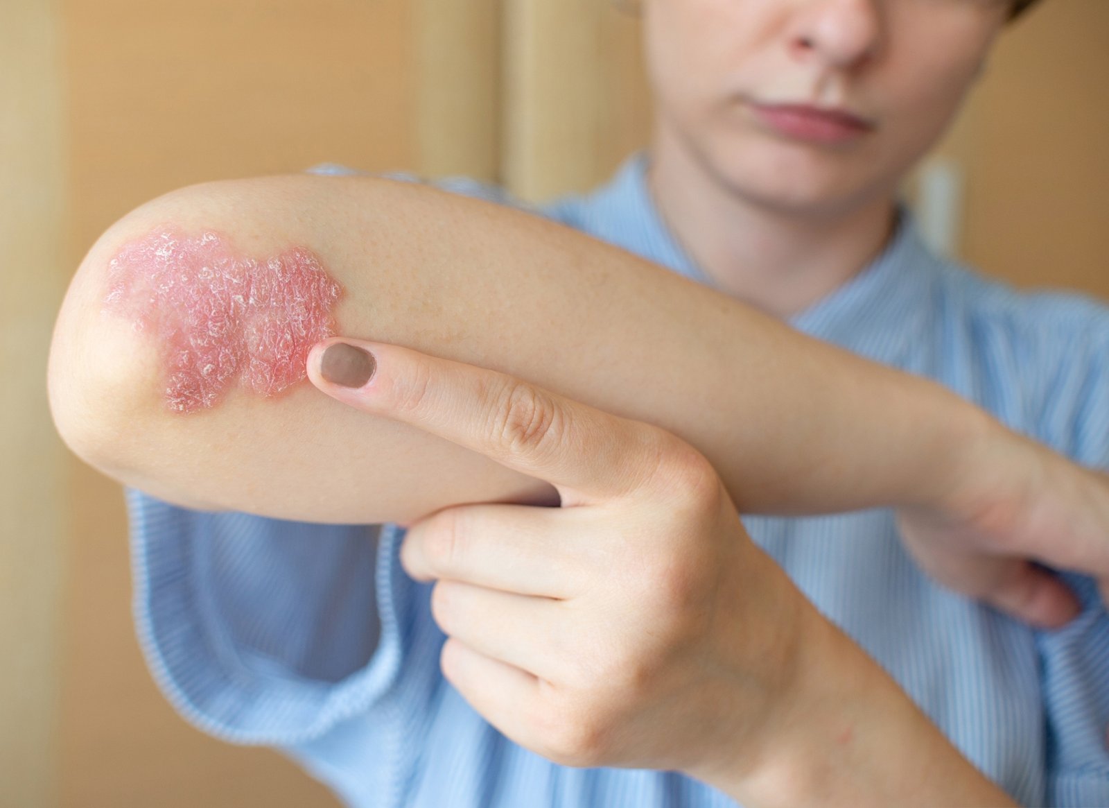 Psoriasis Disease